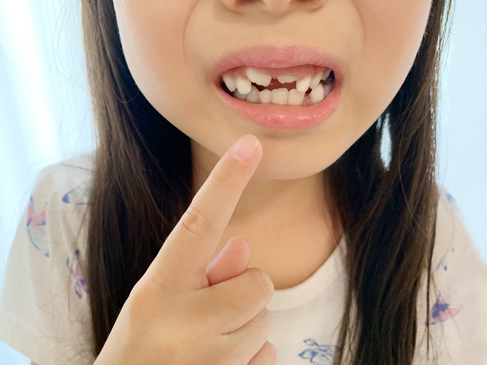 小児矯正について