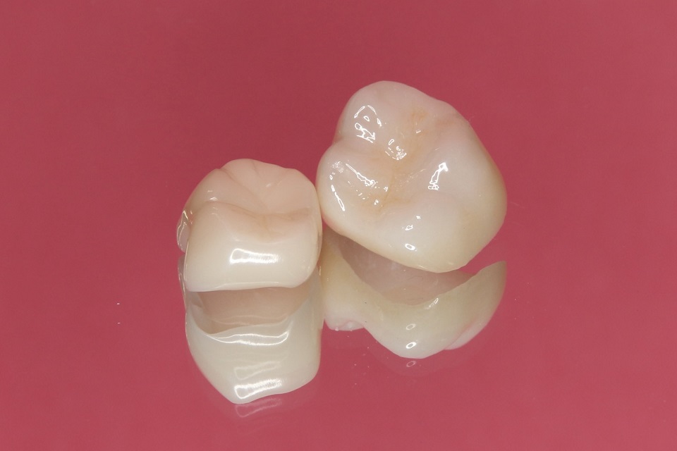 セラミック治療について